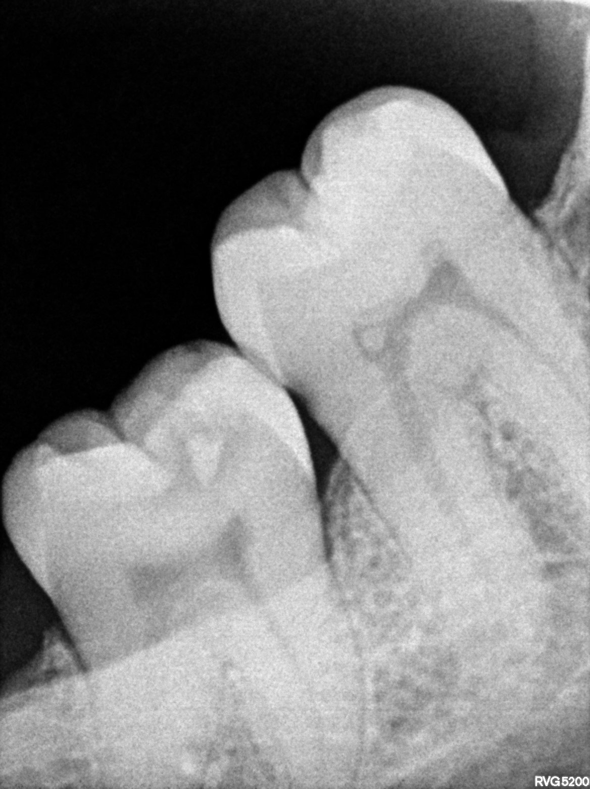 Dental X-ray